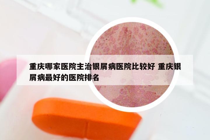 重庆哪家医院主治银屑病医院比较好 重庆银屑病最好的医院排名