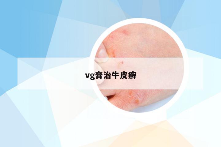 vg膏治牛皮癣