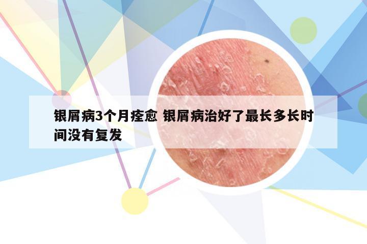 银屑病3个月痊愈 银屑病治好了最长多长时间没有复发