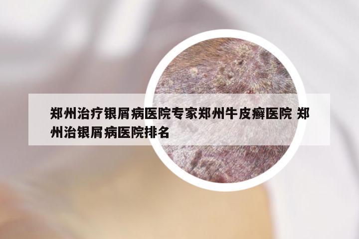 郑州治疗银屑病医院专家郑州牛皮癣医院 郑州治银屑病医院排名