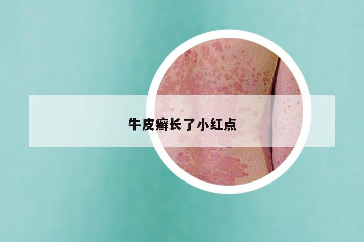 牛皮癣长了小红点
