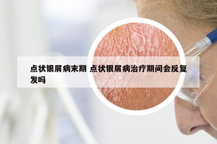 点状银屑病末期 点状银屑病治疗期间会反复发吗