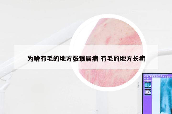 为啥有毛的地方张银屑病 有毛的地方长癣