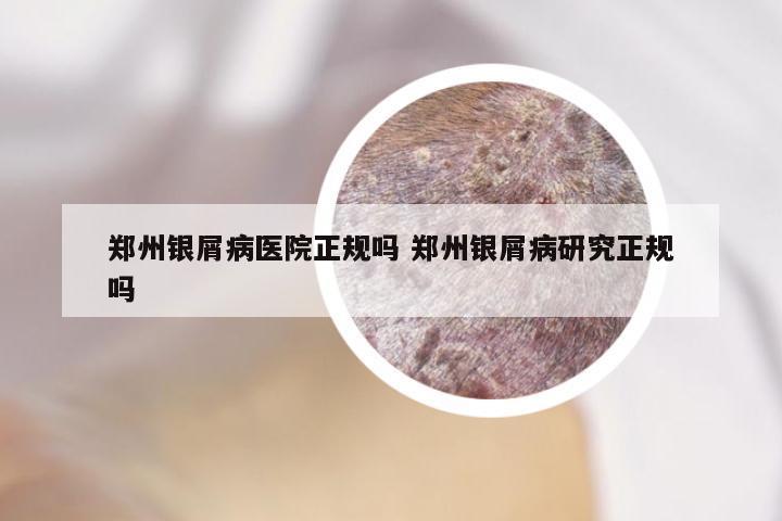 郑州银屑病医院正规吗 郑州银屑病研究正规吗