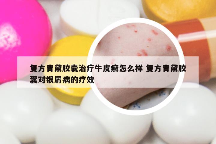 复方青黛胶囊治疗牛皮癣怎么样 复方青黛胶囊对银屑病的疗效