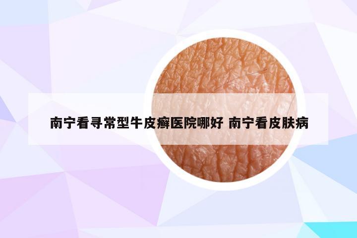 南宁看寻常型牛皮癣医院哪好 南宁看皮肤病