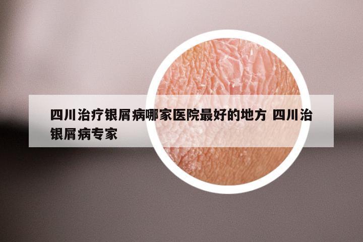 四川治疗银屑病哪家医院最好的地方 四川治银屑病专家