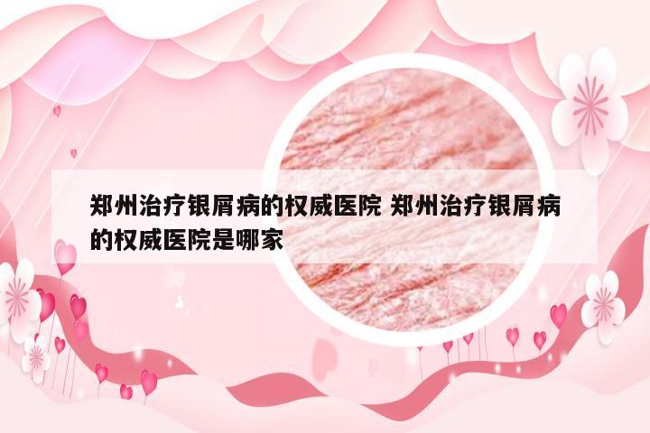 郑州治疗银屑病的权威医院 郑州治疗银屑病的权威医院是哪家
