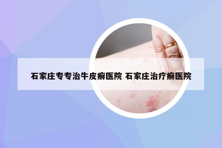 石家庄专专治牛皮癣医院 石家庄治疗癣医院