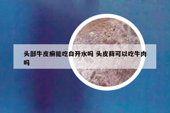 头部牛皮癣能吃白开水吗 头皮藓可以吃牛肉吗