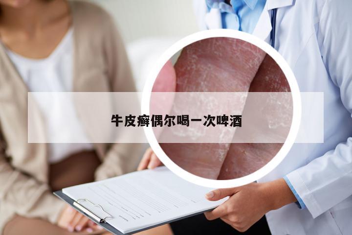 牛皮癣偶尔喝一次啤酒