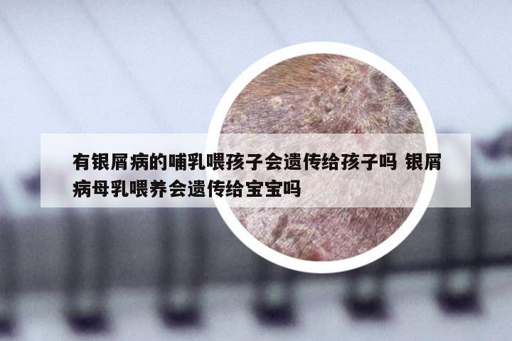有银屑病的哺乳喂孩子会遗传给孩子吗 银屑病母乳喂养会遗传给宝宝吗