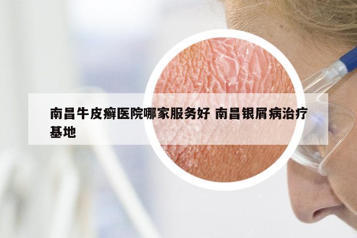 南昌牛皮癣医院哪家服务好 南昌银屑病治疗基地