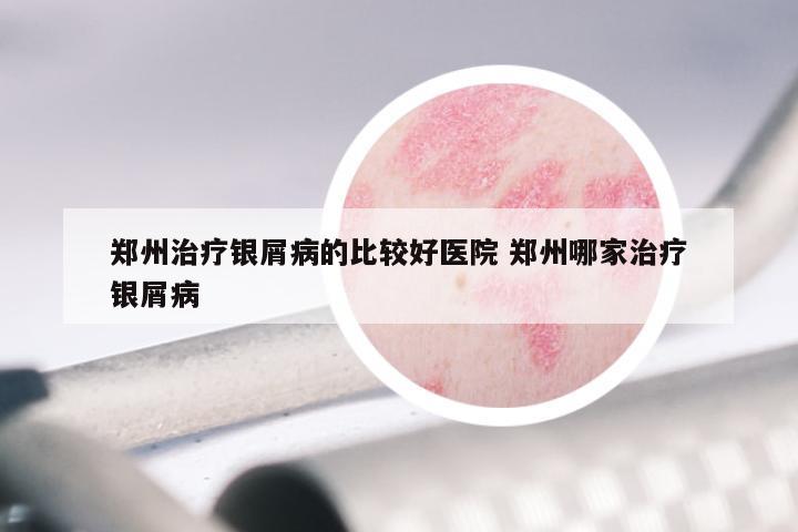 郑州治疗银屑病的比较好医院 郑州哪家治疗银屑病