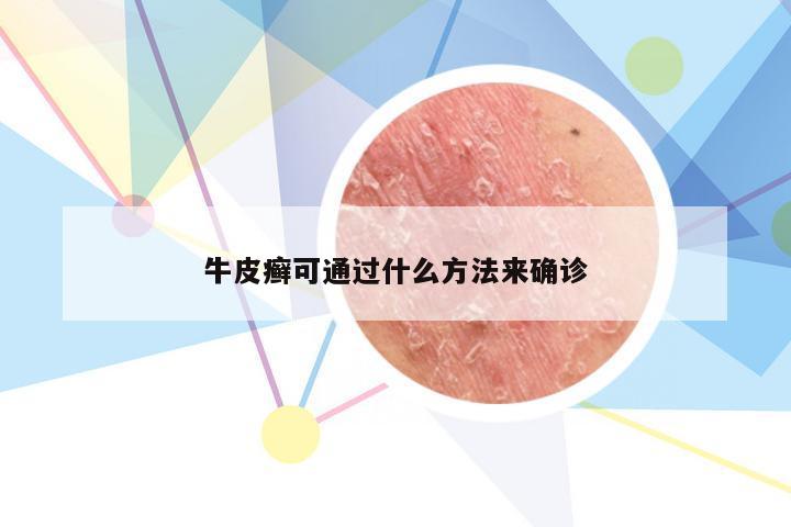牛皮癣可通过什么方法来确诊