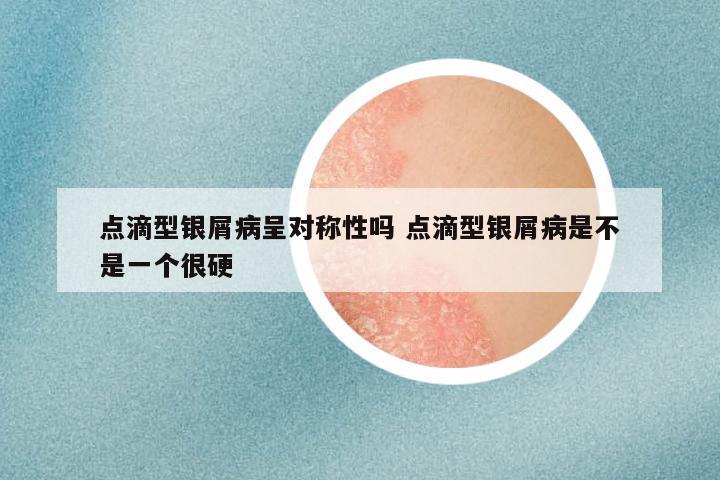 点滴型银屑病呈对称性吗 点滴型银屑病是不是一个很硬