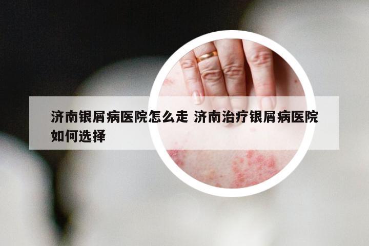 济南银屑病医院怎么走 济南治疗银屑病医院如何选择