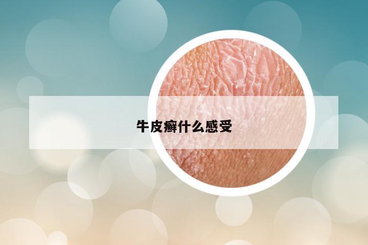 牛皮癣什么感受