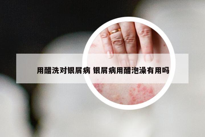 用醋洗对银屑病 银屑病用醋泡澡有用吗