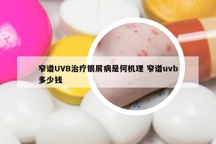 窄谱UVB治疗银屑病是何机理 窄谱uvb多少钱