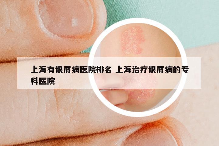上海有银屑病医院排名 上海治疗银屑病的专科医院