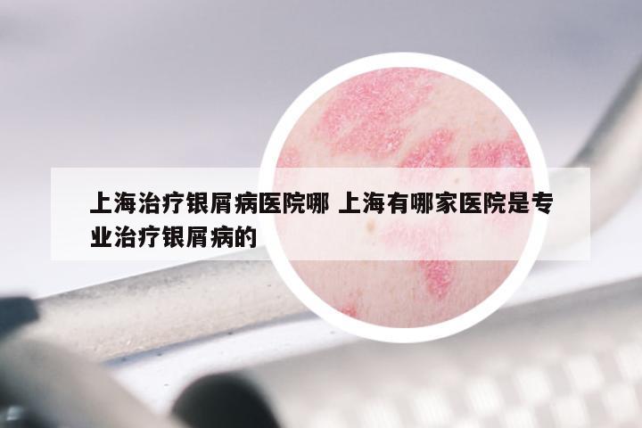 上海治疗银屑病医院哪 上海有哪家医院是专业治疗银屑病的