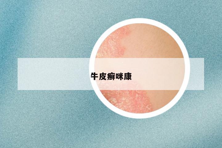 牛皮癣咪康