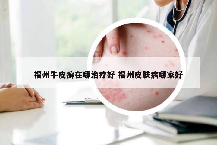 福州牛皮癣在哪治疗好 福州皮肤病哪家好