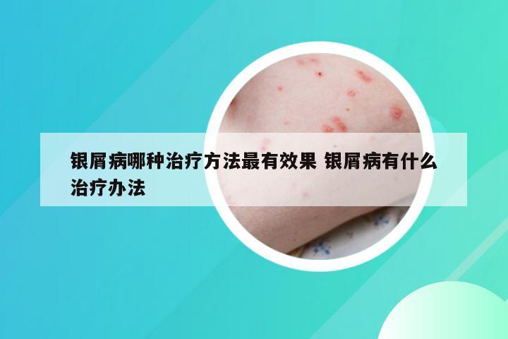 银屑病哪种治疗方法最有效果 银屑病有什么治疗办法