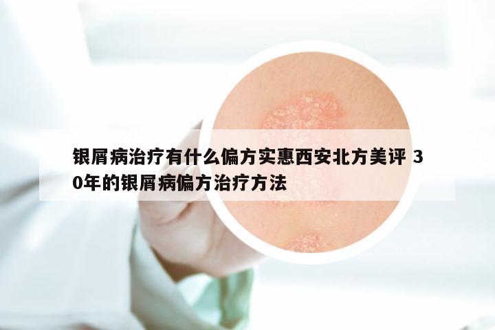 银屑病治疗有什么偏方实惠西安北方美评 30年的银屑病偏方治疗方法