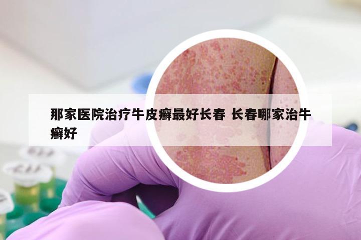 那家医院治疗牛皮癣最好长春 长春哪家治牛癣好