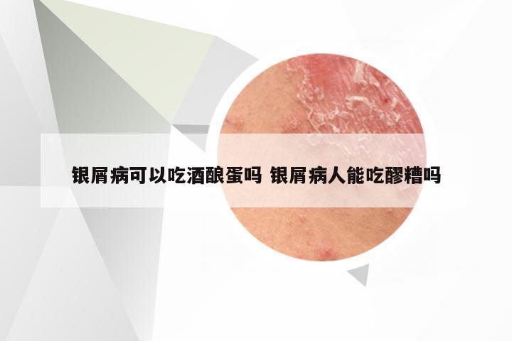 银屑病可以吃酒酿蛋吗 银屑病人能吃醪糟吗