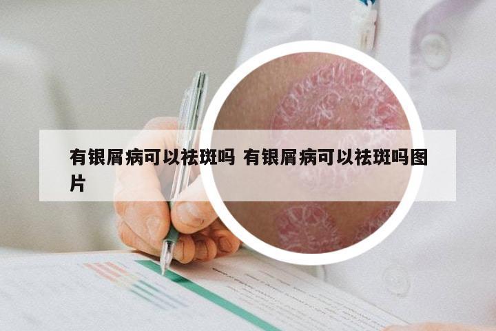 有银屑病可以祛斑吗 有银屑病可以祛斑吗图片