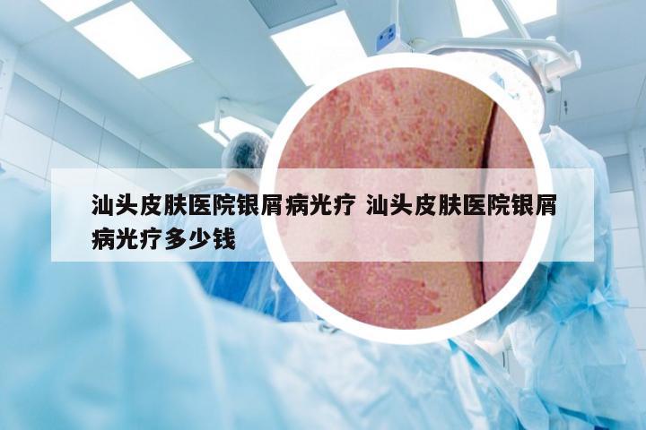 汕头皮肤医院银屑病光疗 汕头皮肤医院银屑病光疗多少钱