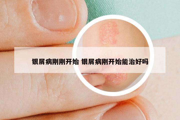 银屑病刚刚开始 银屑病刚开始能治好吗
