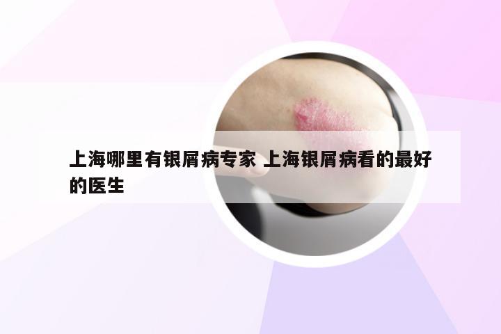 上海哪里有银屑病专家 上海银屑病看的最好的医生