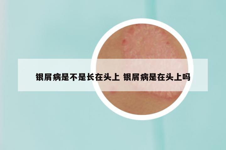 银屑病是不是长在头上 银屑病是在头上吗