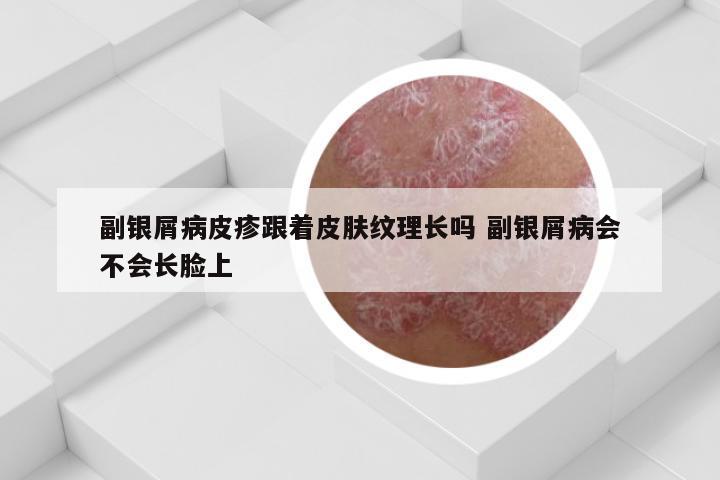 副银屑病皮疹跟着皮肤纹理长吗 副银屑病会不会长脸上