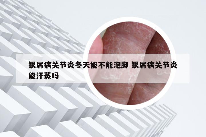 银屑病关节炎冬天能不能泡脚 银屑病关节炎能汗蒸吗