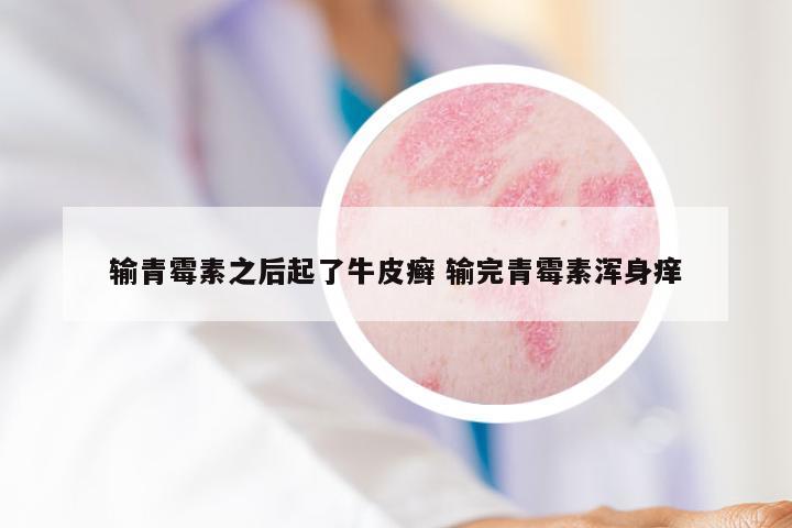 输青霉素之后起了牛皮癣 输完青霉素浑身痒