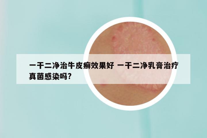 一干二净治牛皮癣效果好 一干二净乳膏治疗真菌感染吗?