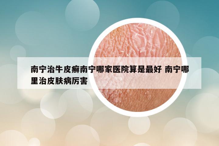 南宁治牛皮癣南宁哪家医院算是最好 南宁哪里治皮肤病厉害