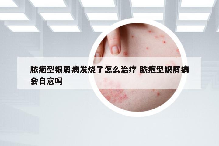 脓疱型银屑病发烧了怎么治疗 脓疱型银屑病会自愈吗