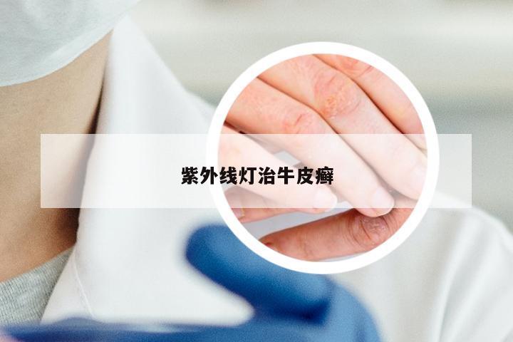 紫外线灯治牛皮癣