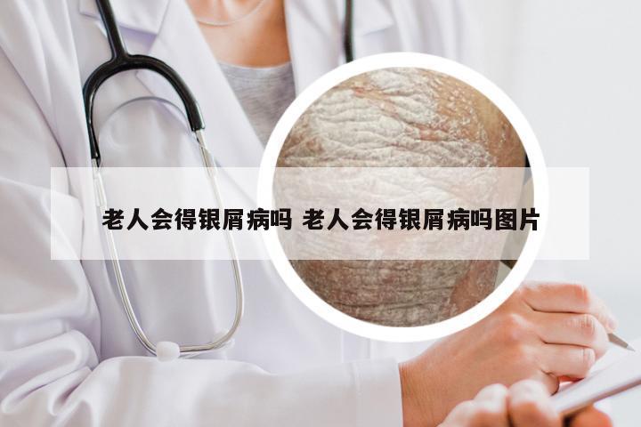 老人会得银屑病吗 老人会得银屑病吗图片