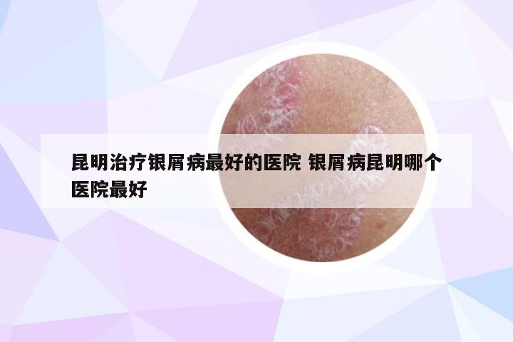 昆明治疗银屑病最好的医院 银屑病昆明哪个医院最好