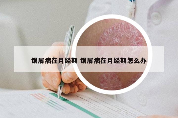 银屑病在月经期 银屑病在月经期怎么办