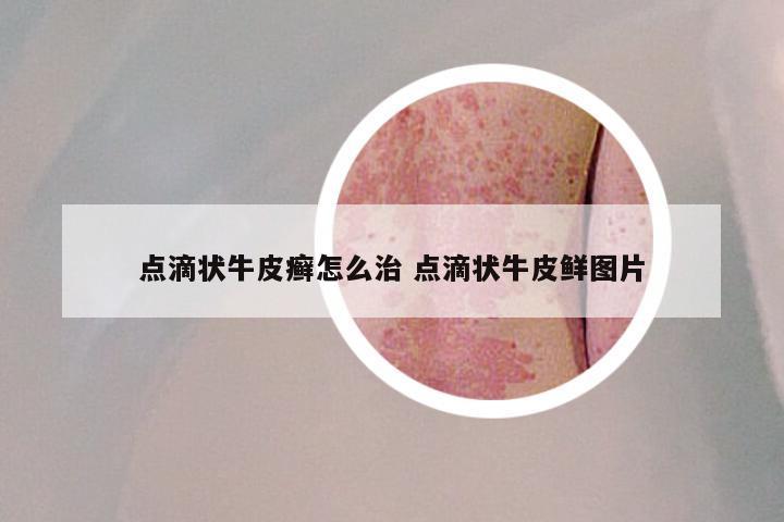 点滴状牛皮癣怎么治 点滴状牛皮鲜图片