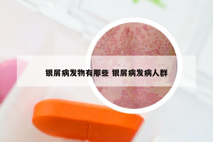银屑病发物有那些 银屑病发病人群