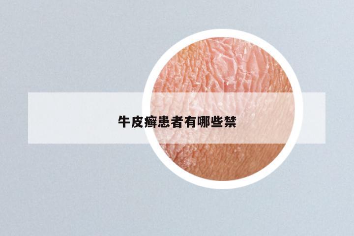 牛皮癣患者有哪些禁